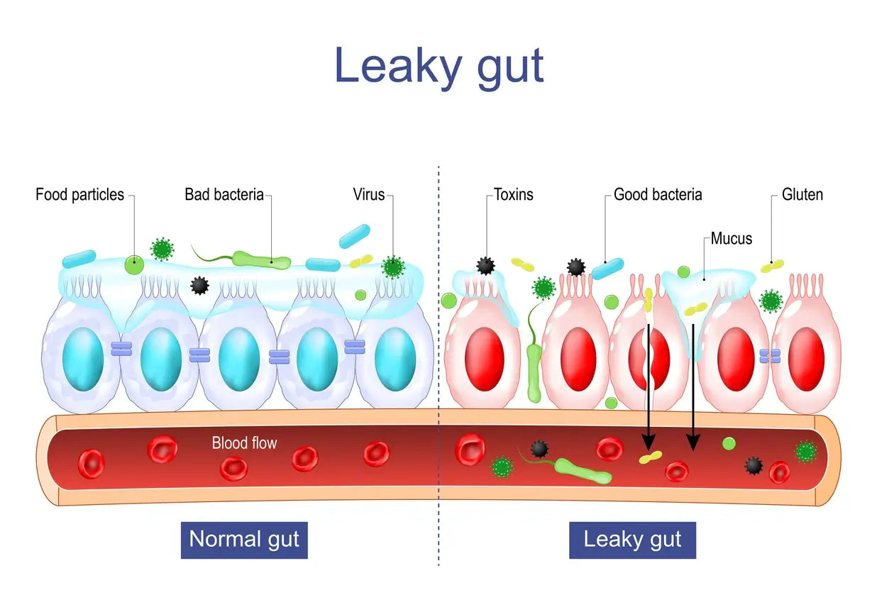 Leaky Gut Syndrome: What Science Says About Intestinal Permeability